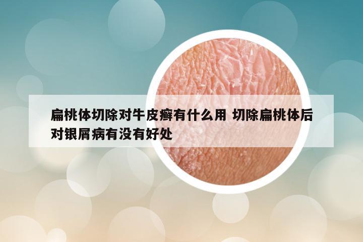 扁桃体切除对牛皮癣有什么用 切除扁桃体后对银屑病有没有好处