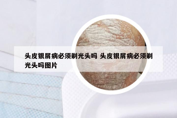 头皮银屑病必须剃光头吗 头皮银屑病必须剃光头吗图片
