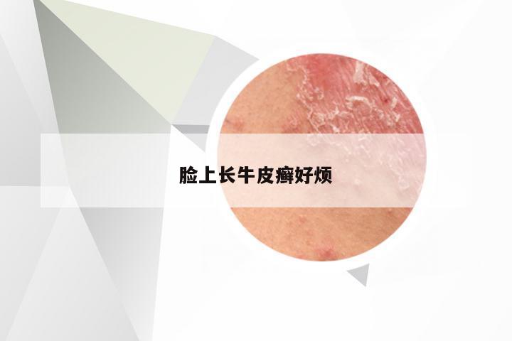 脸上长牛皮癣好烦