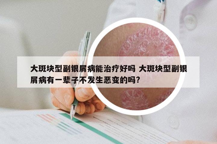 大斑块型副银屑病能治疗好吗 大斑块型副银屑病有一辈子不发生恶变的吗?