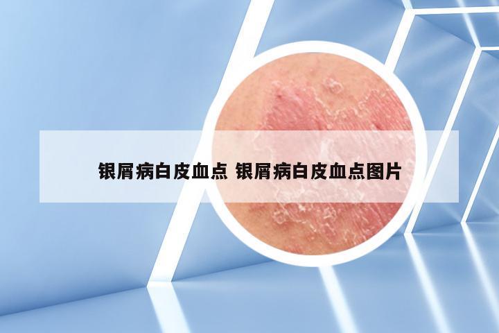 银屑病白皮血点 银屑病白皮血点图片
