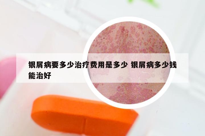 银屑病要多少治疗费用是多少 银屑病多少钱能治好