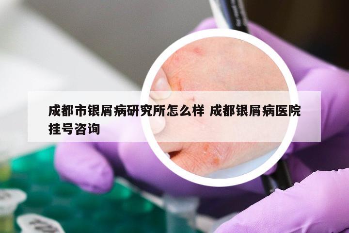 成都市银屑病研究所怎么样 成都银屑病医院挂号咨询