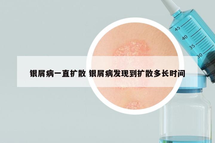 银屑病一直扩散 银屑病发现到扩散多长时间