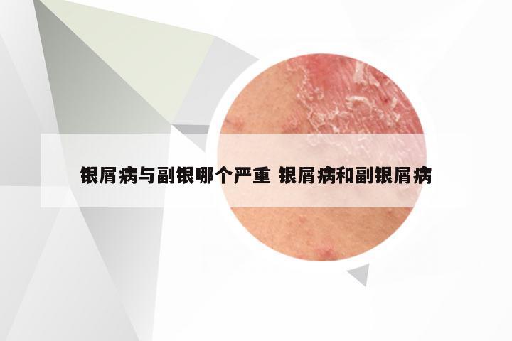 银屑病与副银哪个严重 银屑病和副银屑病