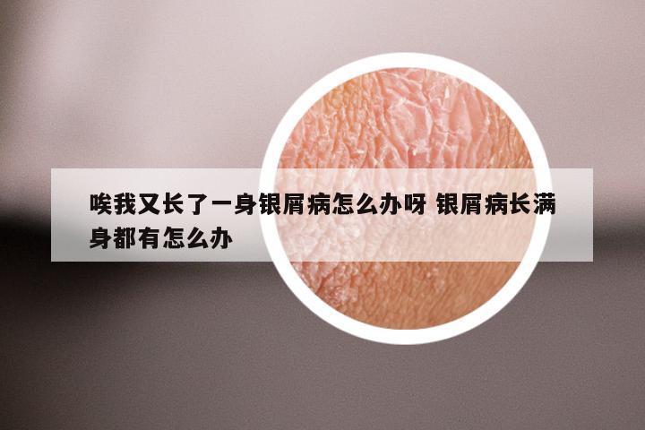 唉我又长了一身银屑病怎么办呀 银屑病长满身都有怎么办