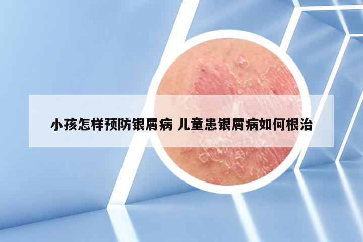 小孩怎样预防银屑病 儿童患银屑病如何根治