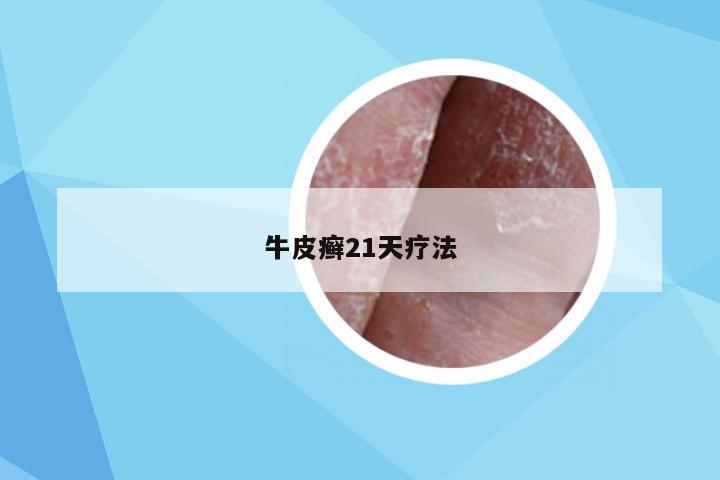 牛皮癣21天疗法