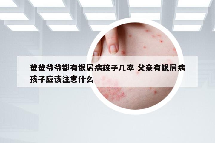 爸爸爷爷都有银屑病孩子几率 父亲有银屑病孩子应该注意什么