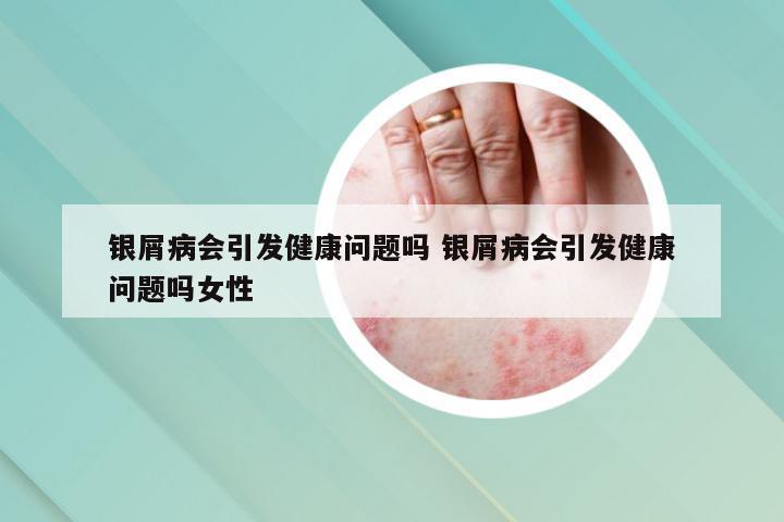 银屑病会引发健康问题吗 银屑病会引发健康问题吗女性