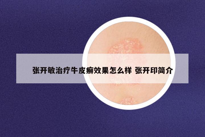 张开敏治疗牛皮癣效果怎么样 张开印简介