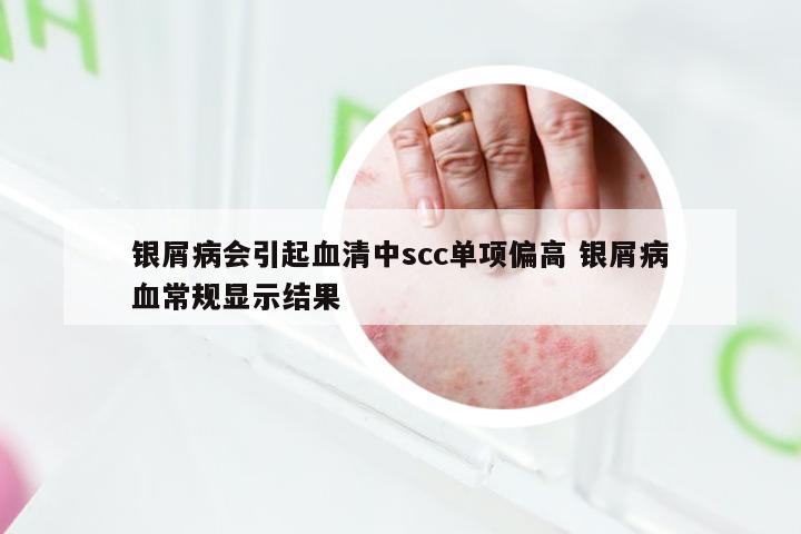 银屑病会引起血清中scc单项偏高 银屑病血常规显示结果