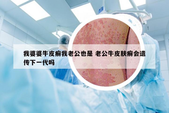 我婆婆牛皮癣我老公也是 老公牛皮肤癣会遗传下一代吗