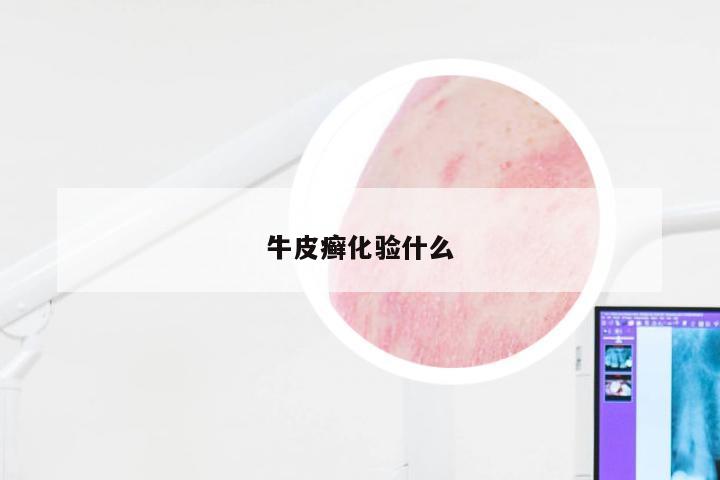 牛皮癣化验什么