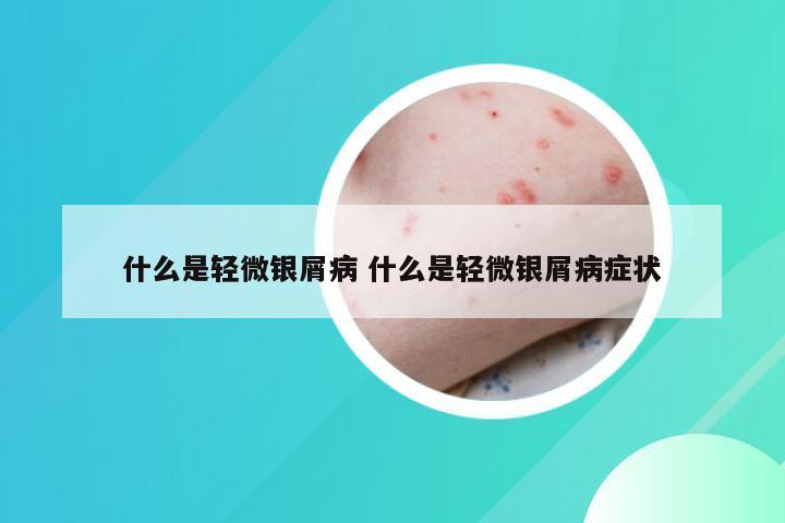 什么是轻微银屑病 什么是轻微银屑病症状