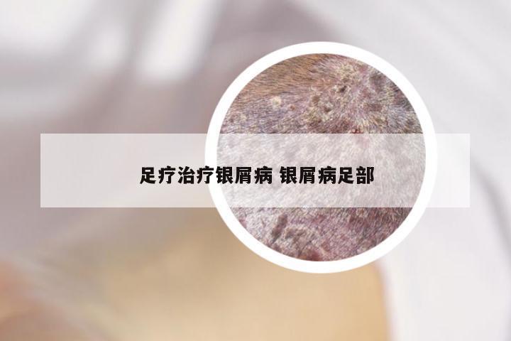 足疗治疗银屑病 银屑病足部