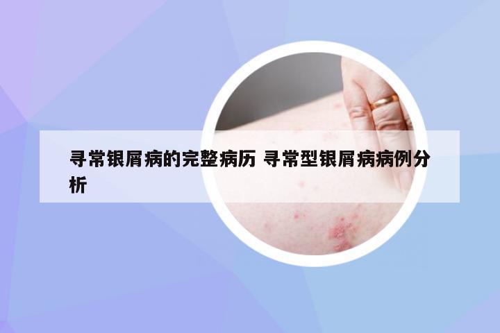 寻常银屑病的完整病历 寻常型银屑病病例分析
