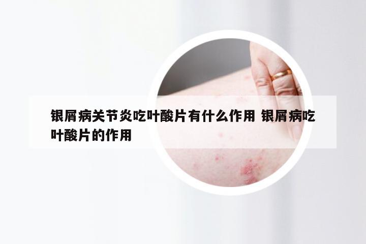 银屑病关节炎吃叶酸片有什么作用 银屑病吃叶酸片的作用