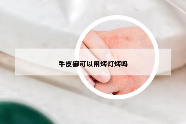 牛皮癣可以用烤灯烤吗