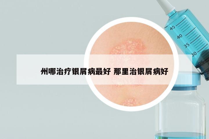 州哪治疗银屑病最好 那里治银屑病好