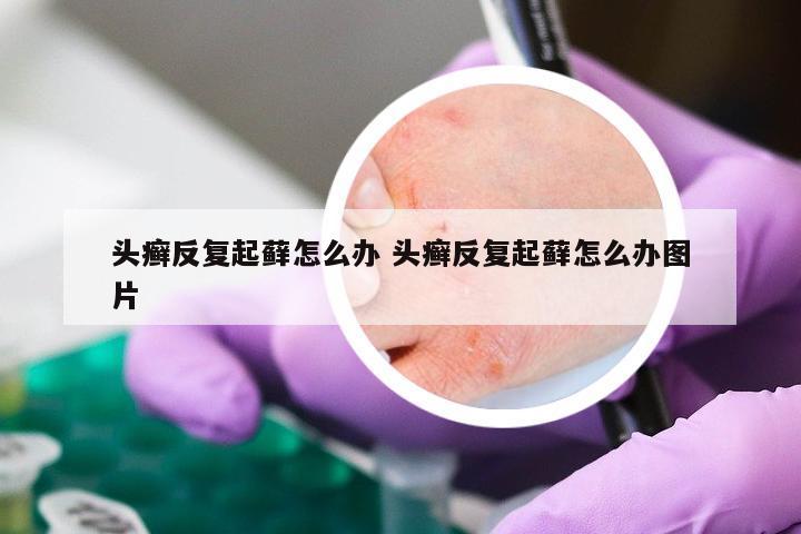 头癣反复起藓怎么办 头癣反复起藓怎么办图片