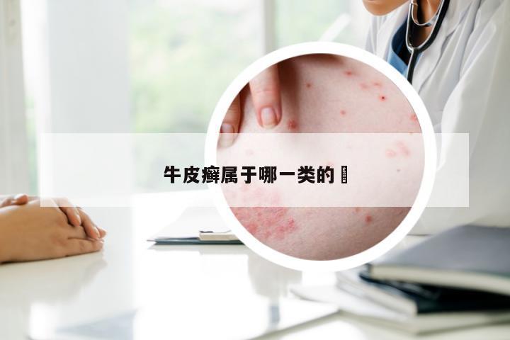 牛皮癣属于哪一类的廯