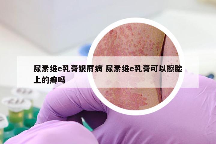 尿素维e乳膏银屑病 尿素维e乳膏可以擦脸上的癣吗