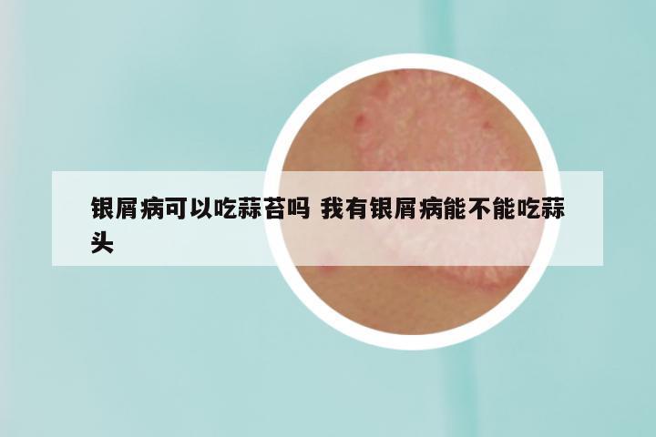 银屑病可以吃蒜苔吗 我有银屑病能不能吃蒜头