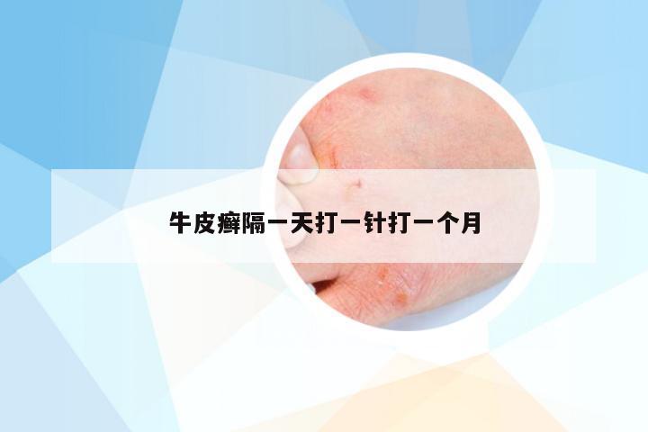 牛皮癣隔一天打一针打一个月