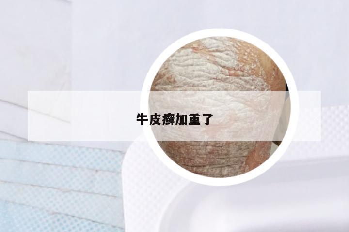 牛皮癣加重了