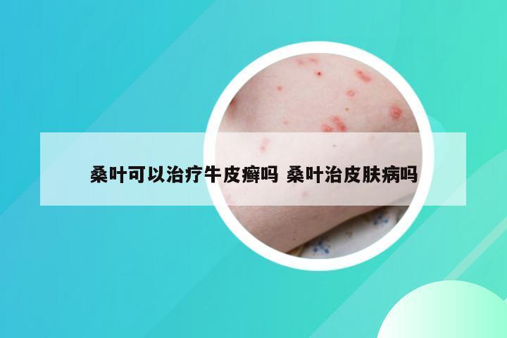 桑叶可以治疗牛皮癣吗 桑叶治皮肤病吗