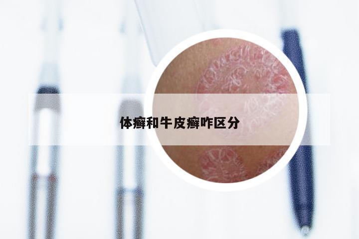 体癣和牛皮癣咋区分