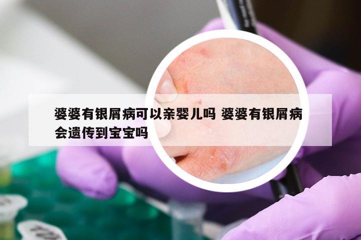 婆婆有银屑病可以亲婴儿吗 婆婆有银屑病 会遗传到宝宝吗