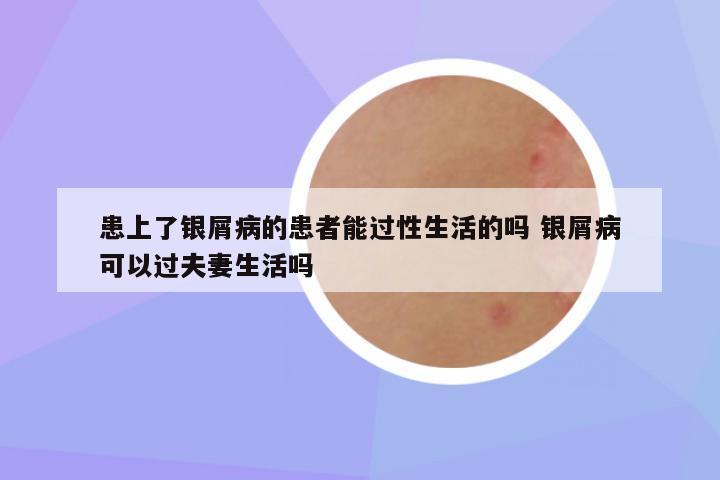 患上了银屑病的患者能过性生活的吗 银屑病可以过夫妻生活吗