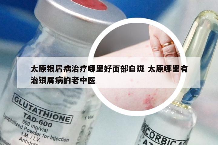 太原银屑病治疗哪里好面部白斑 太原哪里有治银屑病的老中医