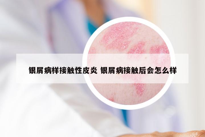 银屑病样接触性皮炎 银屑病接触后会怎么样