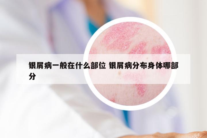 银屑病一般在什么部位 银屑病分布身体哪部分