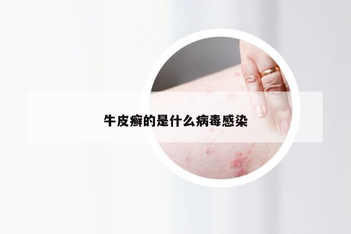牛皮癣的是什么病毒感染