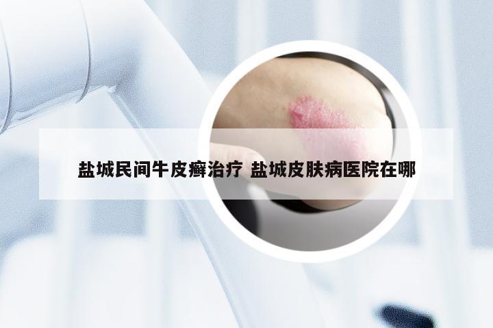 盐城民间牛皮癣治疗 盐城皮肤病医院在哪