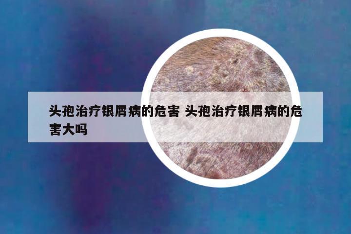 头孢治疗银屑病的危害 头孢治疗银屑病的危害大吗