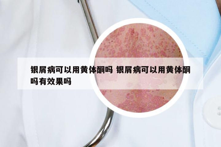 银屑病可以用黄体酮吗 银屑病可以用黄体酮吗有效果吗