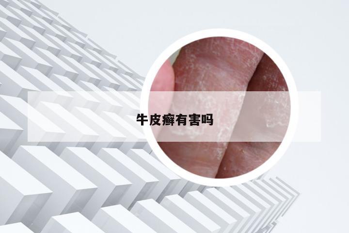 牛皮癣有害吗