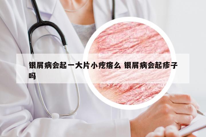 银屑病会起一大片小疙瘩么 银屑病会起疹子吗