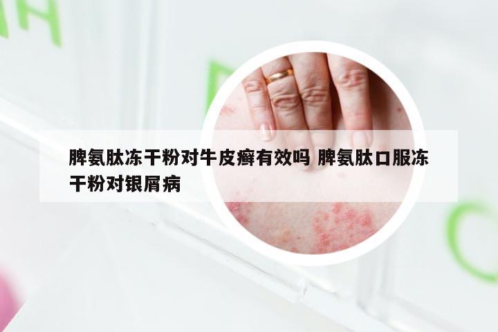 脾氨肽冻干粉对牛皮癣有效吗 脾氨肽口服冻干粉对银屑病