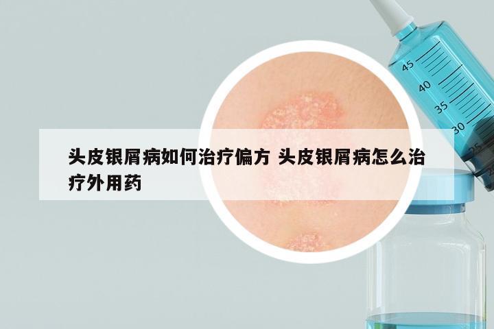头皮银屑病如何治疗偏方 头皮银屑病怎么治疗外用药