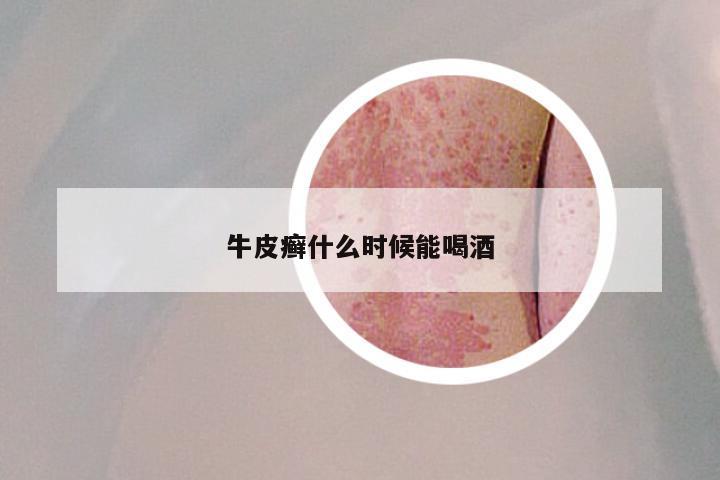 牛皮癣什么时候能喝酒