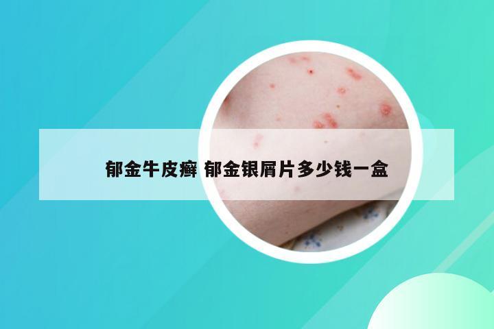 郁金牛皮癣 郁金银屑片多少钱一盒