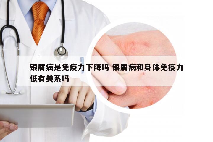 银屑病是免疫力下降吗 银屑病和身体免疫力低有关系吗