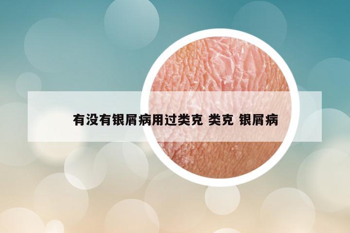 有没有银屑病用过类克 类克 银屑病
