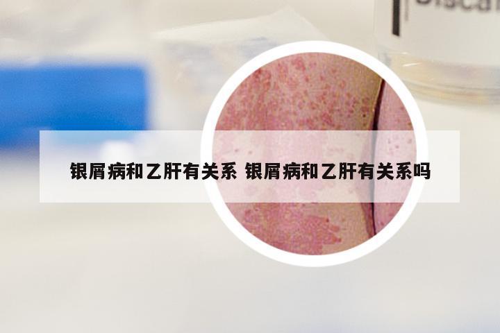 银屑病和乙肝有关系 银屑病和乙肝有关系吗